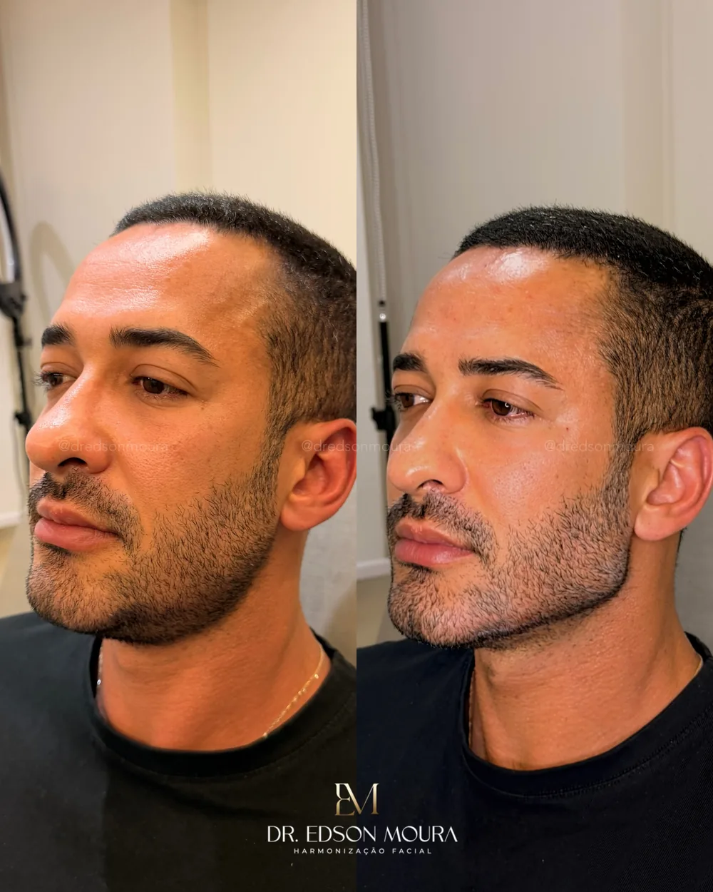 Antes e depois: full face masculino, paciente do Dr. Edson Moura