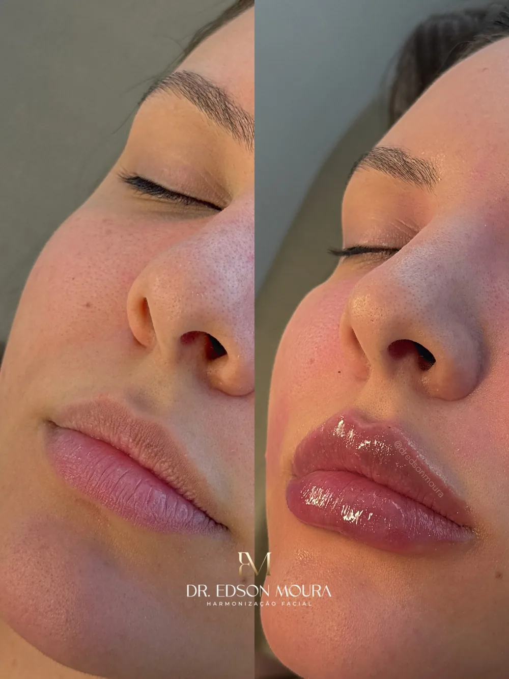 Antes e depois: preenchimento labial, paciente do Dr. Edson Moura