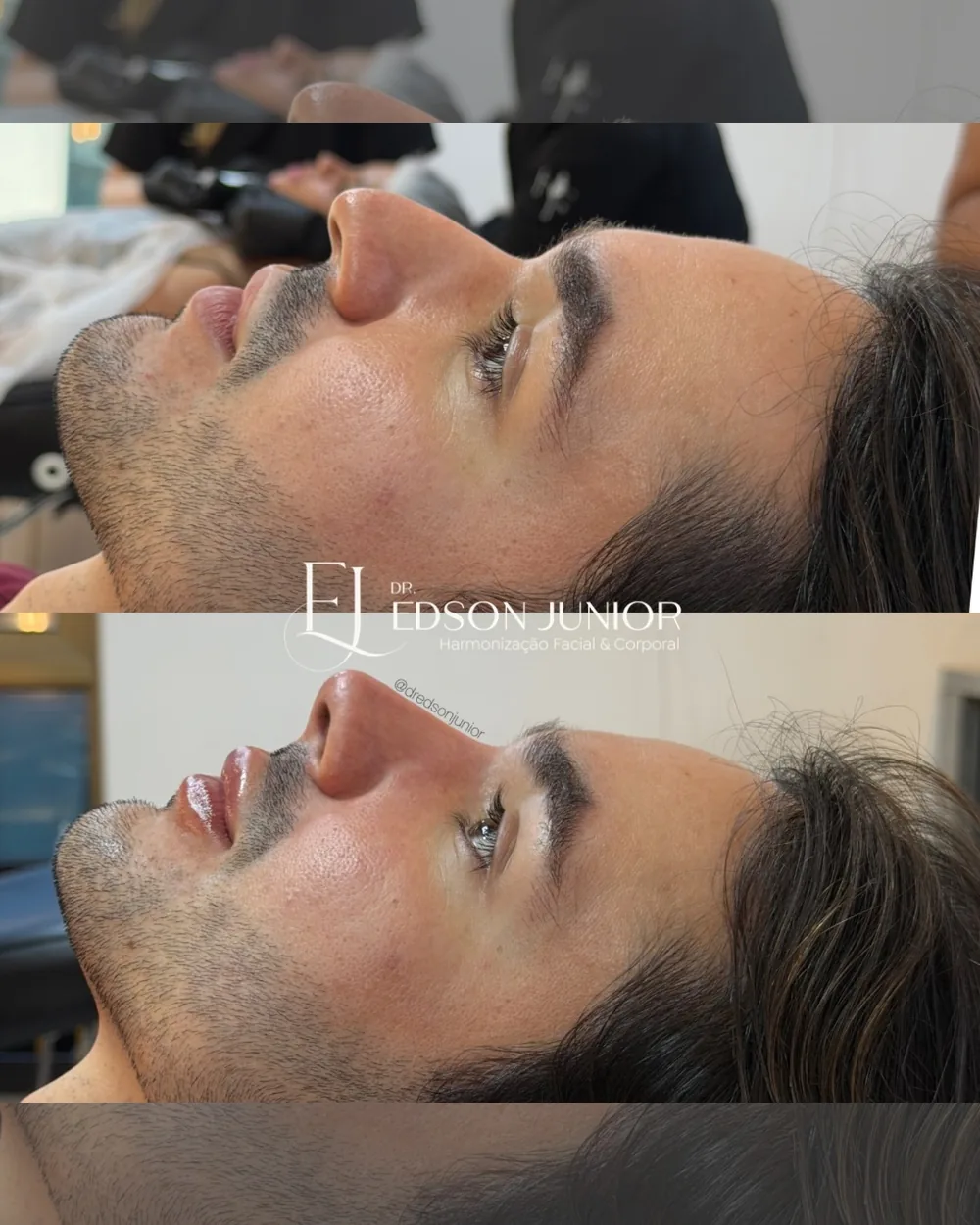 Antes e depois: rinomodelação, paciente do Dr. Edson Moura