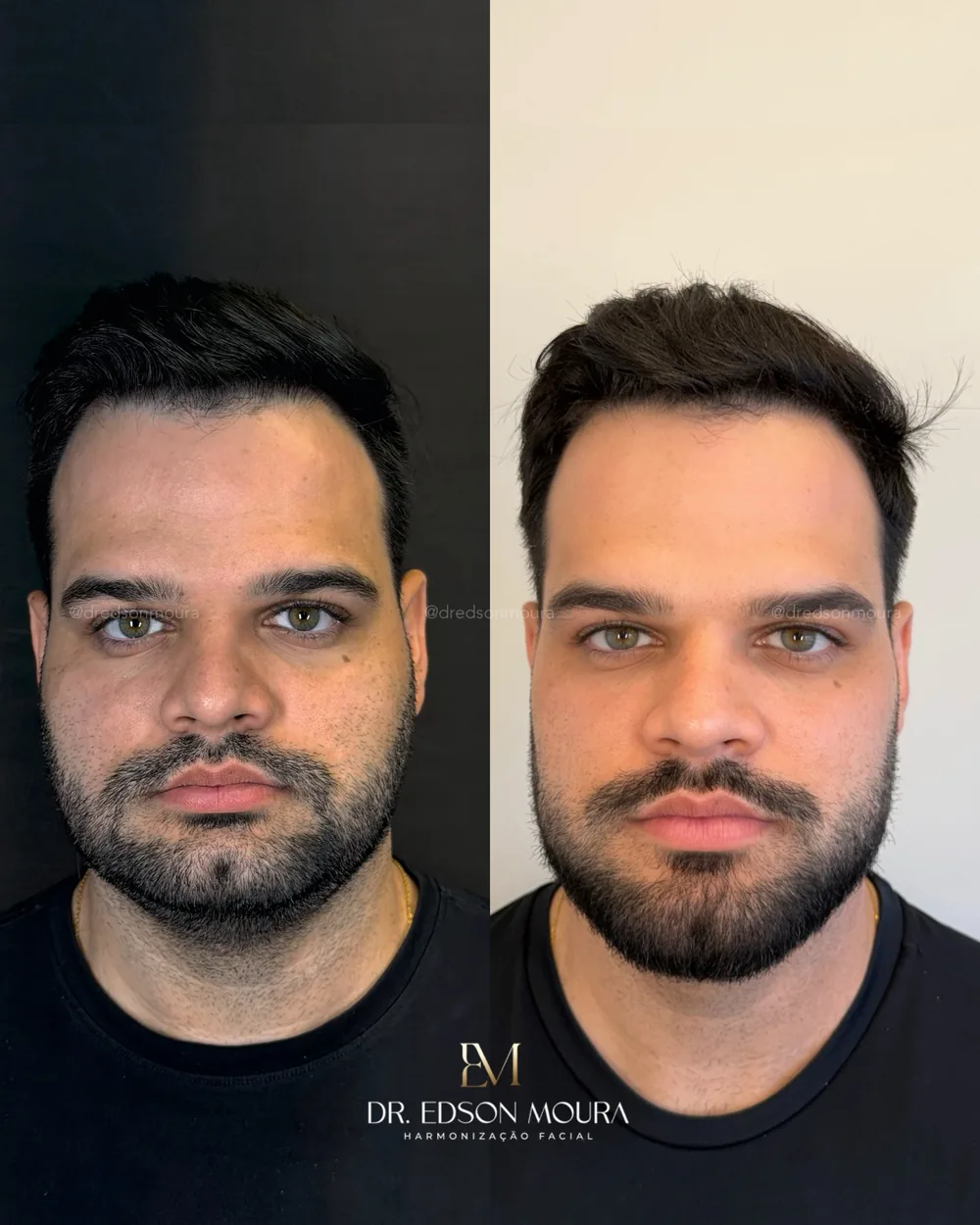 Antes e depois: full face, paciente do Dr. Edson Moura