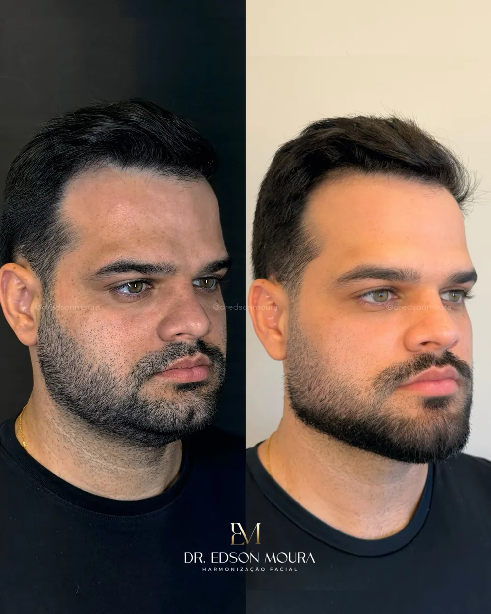 Antes e depois: full face, paciente do Dr. Edson Moura