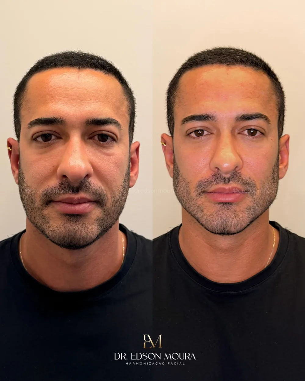 Antes e depois: full face masculino, paciente do Dr. Edson Moura