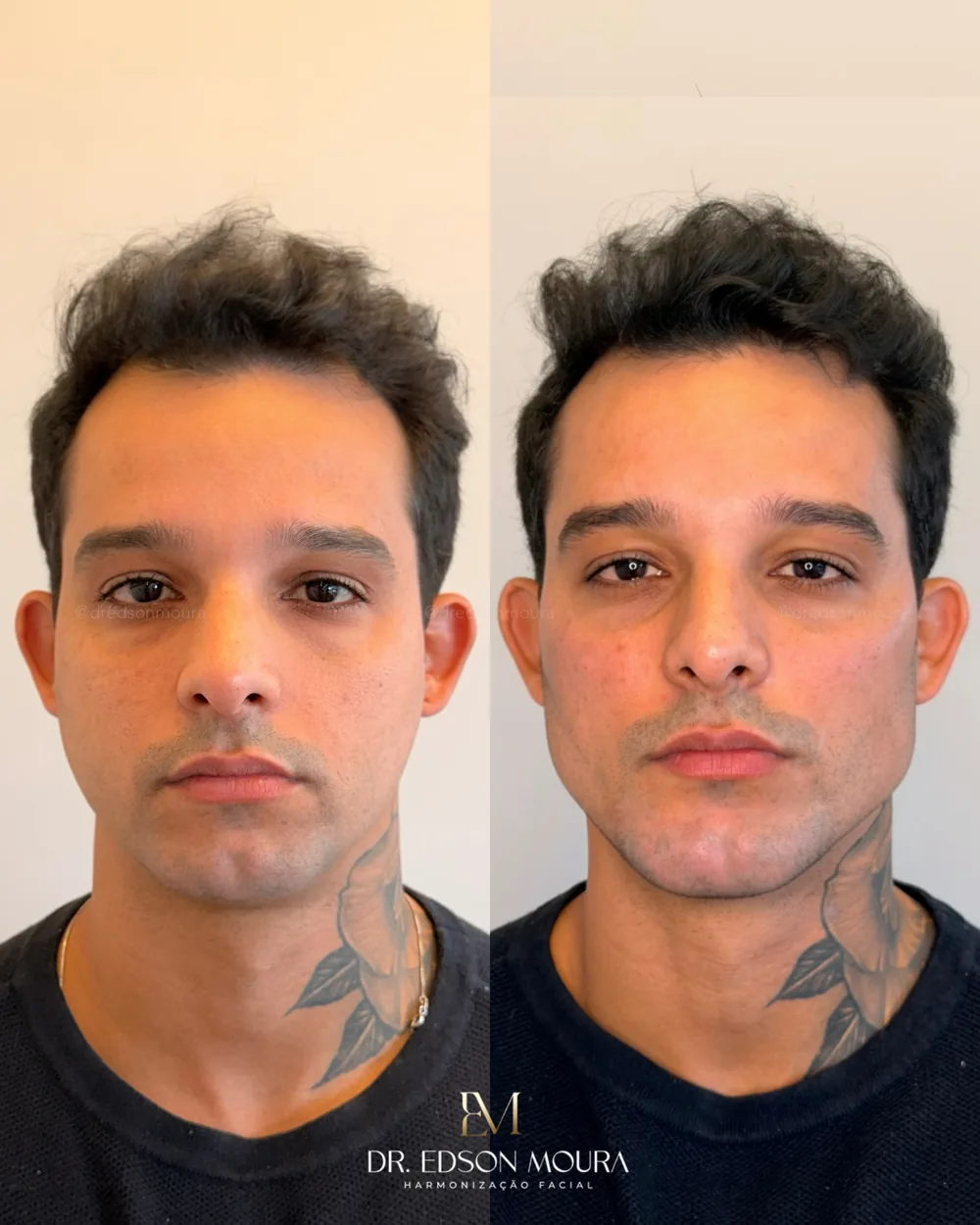 Antes e depois: full face masculino, paciente do Dr. Edson Moura