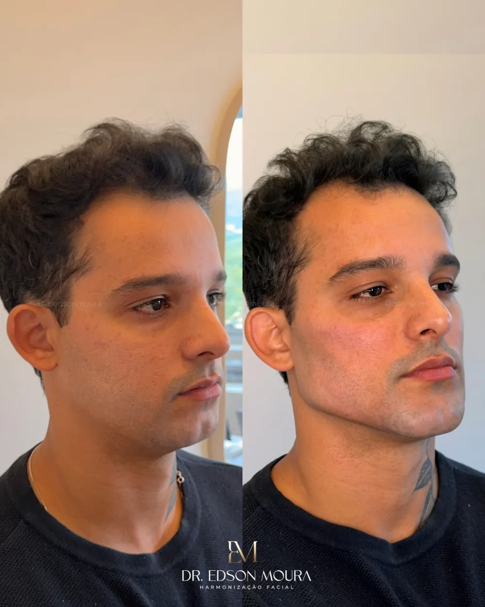 Antes e depois: full face masculino, paciente do Dr. Edson Moura