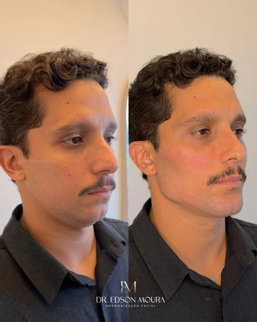 Antes e depois: perfiloplastia, paciente do Dr. Edson Moura