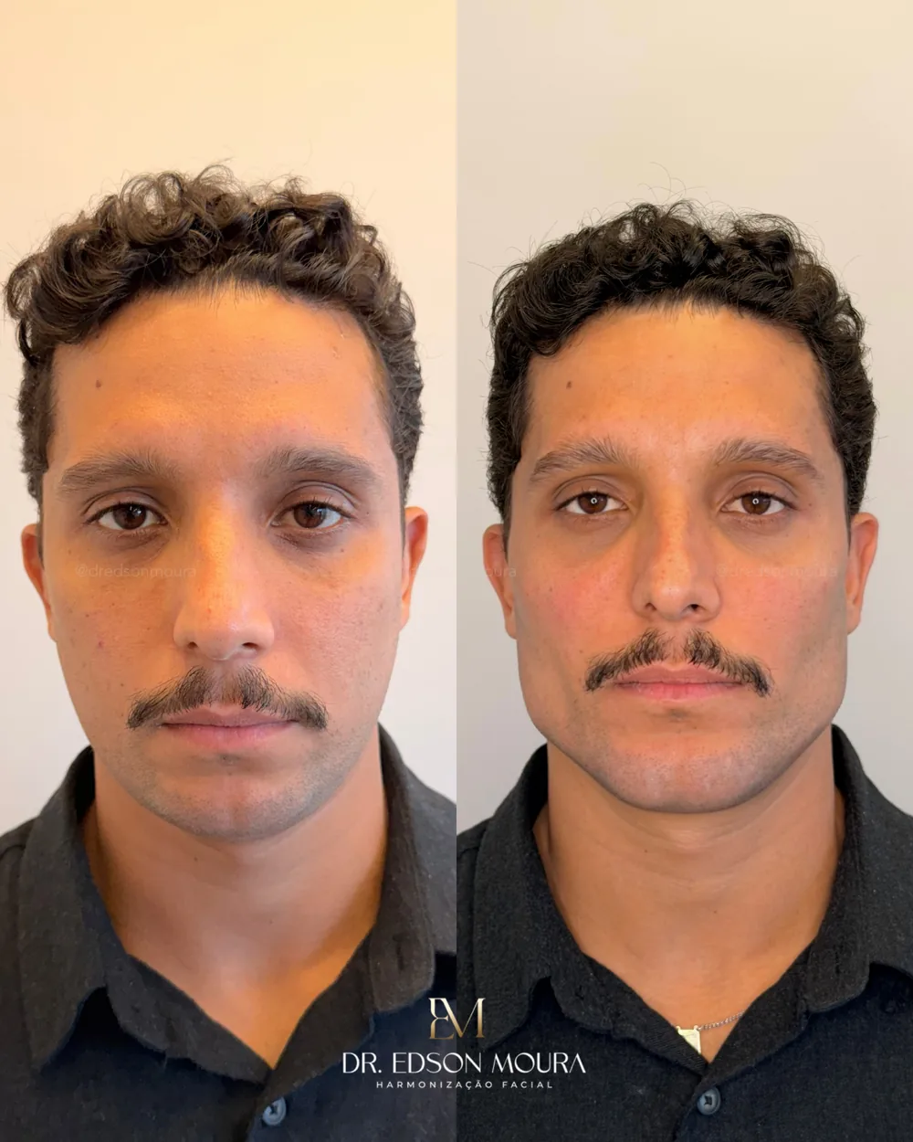 Antes e depois: perfiloplastia, paciente do Dr. Edson Moura