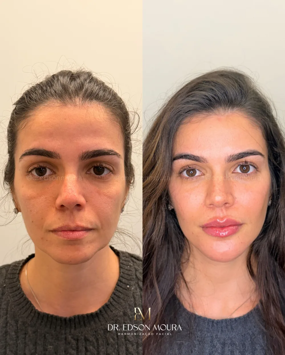 Antes e depois: full face feminino, paciente do Dr. Edson Moura