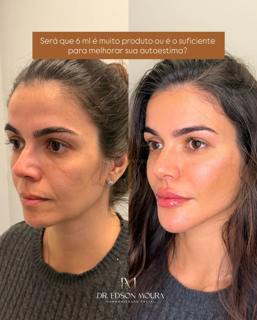 Antes e depois: full face feminino, paciente do Dr. Edson Moura