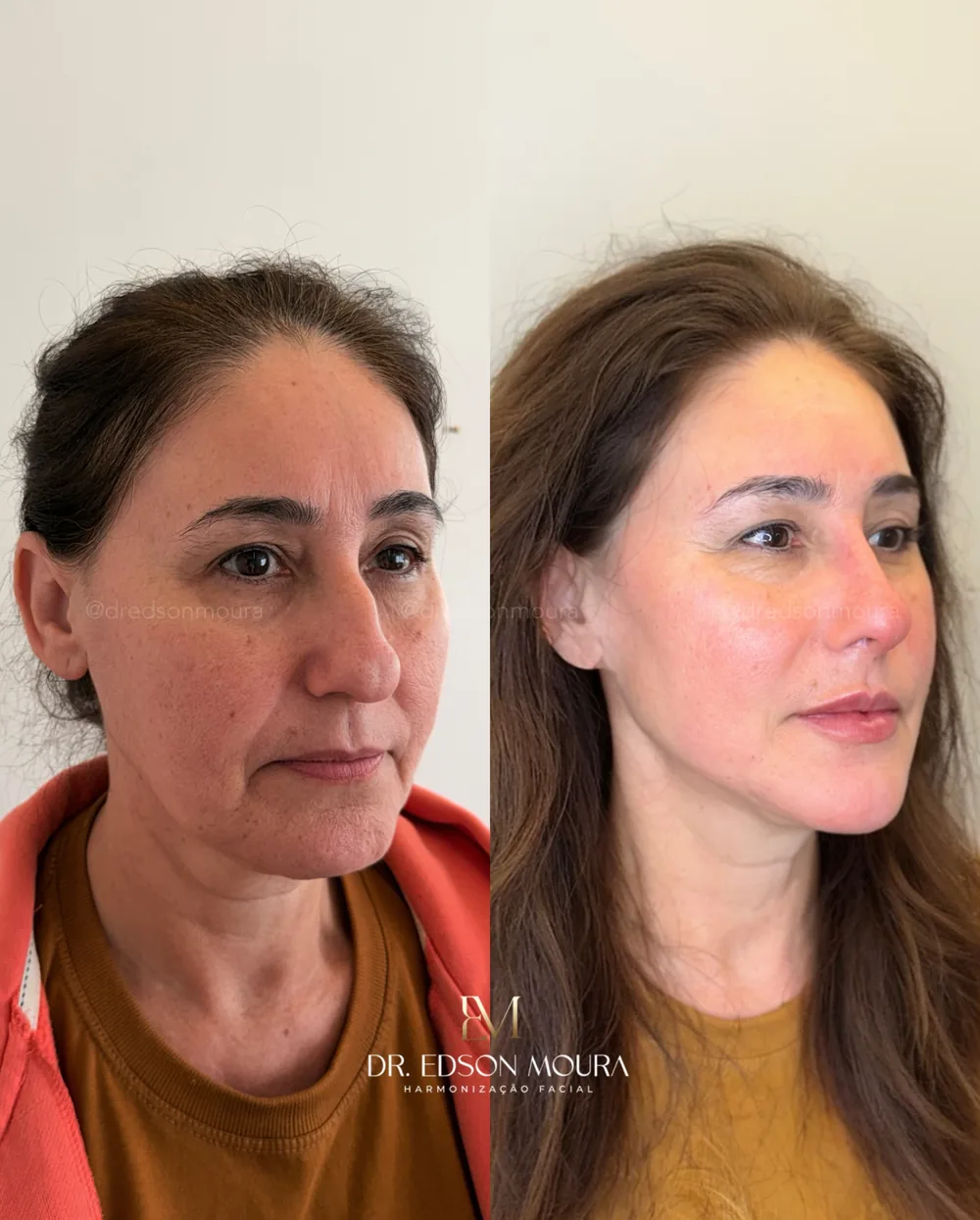 Antes e depois: full face feminino, paciente do Dr. Edson Moura