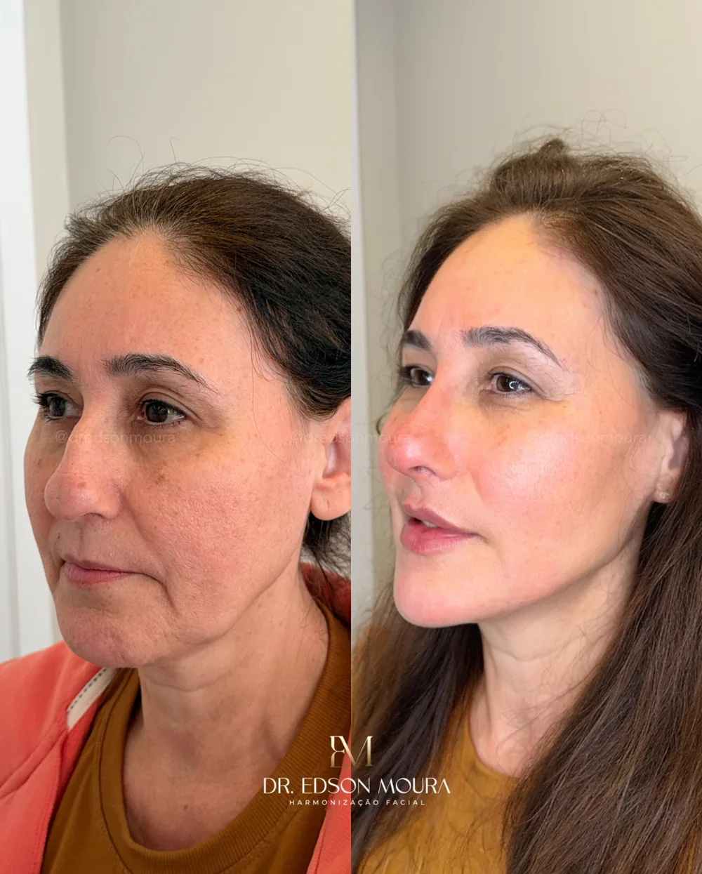 Antes e depois: full face feminino, paciente do Dr. Edson Moura