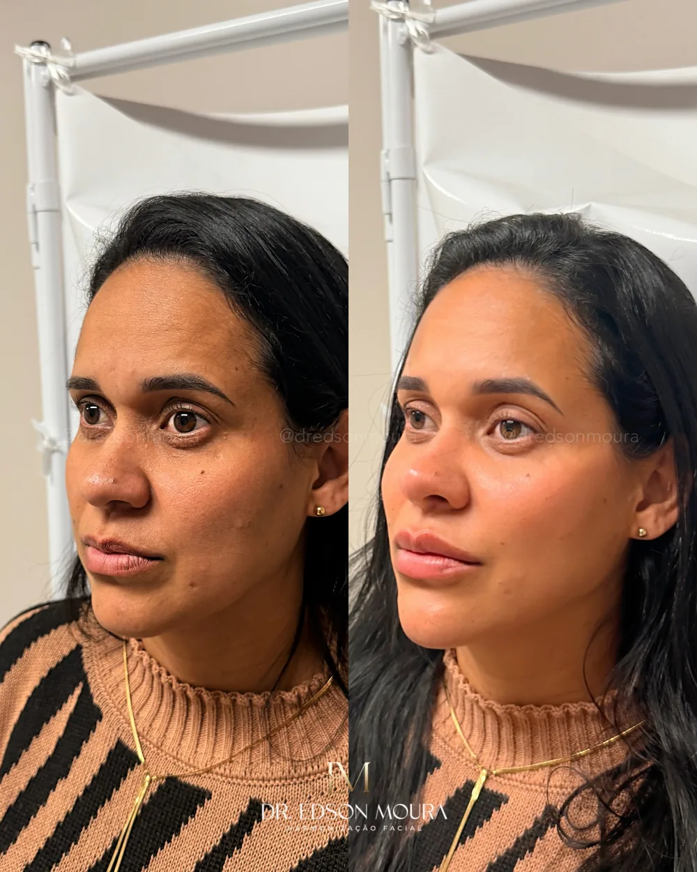Antes e depois: olhar e terço médio, paciente do Dr. Edson Moura