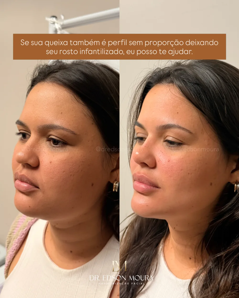 Antes e depois: full face feminino, paciente do Dr. Edson Moura