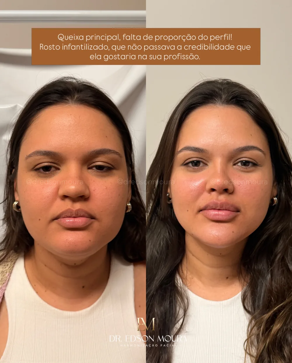 Antes e depois: full face feminino, paciente do Dr. Edson Moura