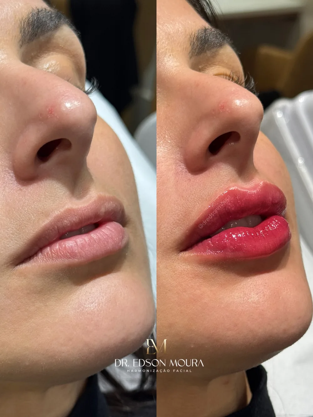 Antes e depois: preenchimento labial, paciente do Dr. Edson Moura