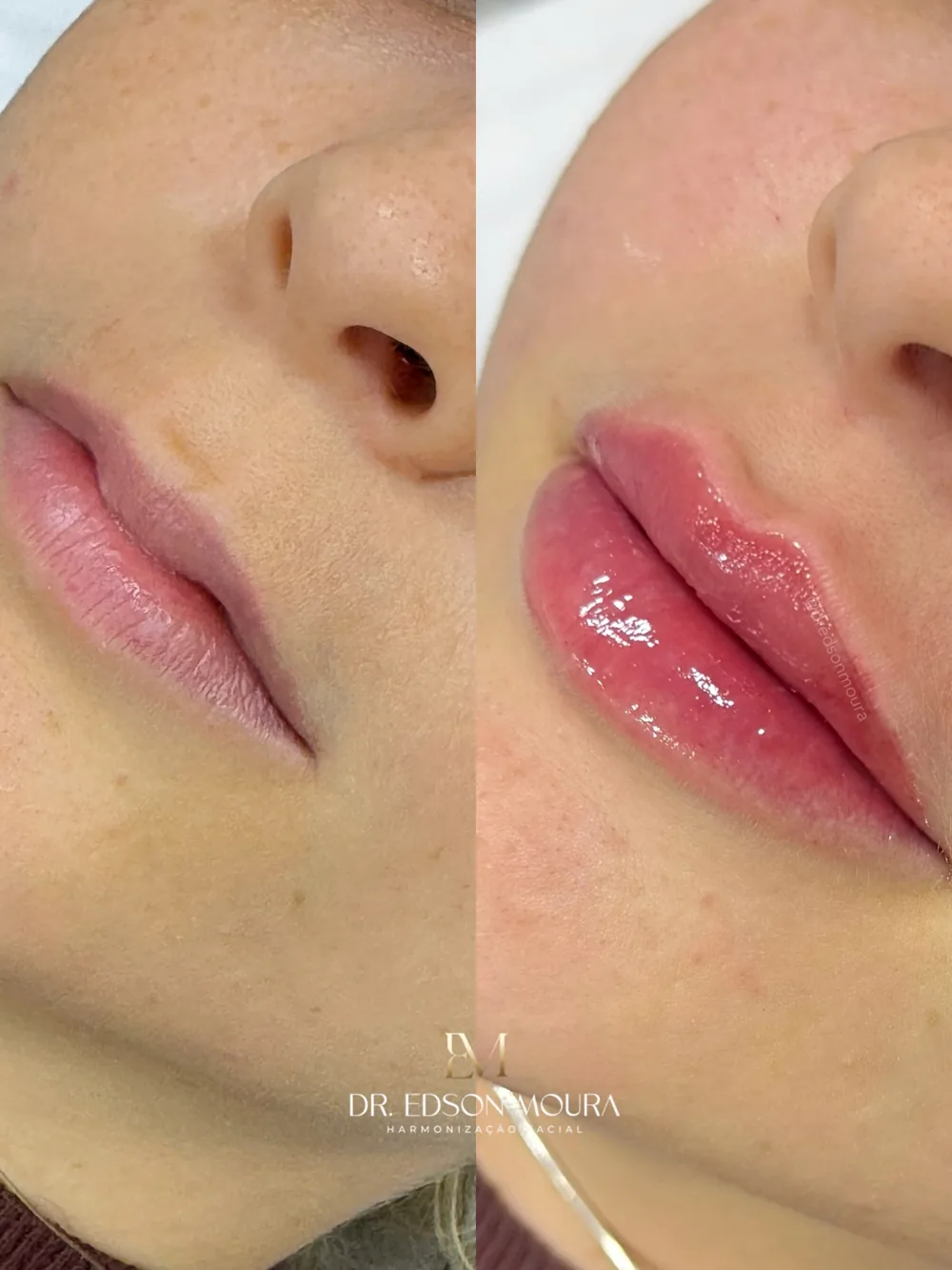 Antes e depois: preenchimento labial, paciente do Dr. Edson Moura
